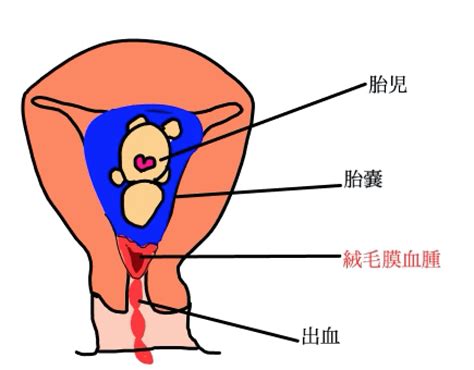 胎盤形成出血|【医師監修】妊娠中に出血を伴う症状、絨毛膜下血腫。